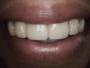 veneers-set4-B