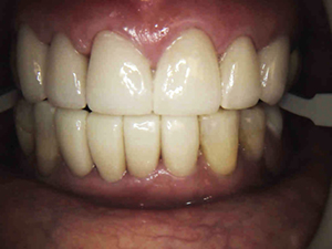 veneers-set5-B-300x325